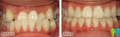 張春利地包天矯正案例