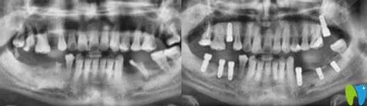 東莞好佰年口腔周勇好不好？來看真人案例