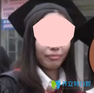 沒有去東莞好佰年口腔做牙齒矯正前