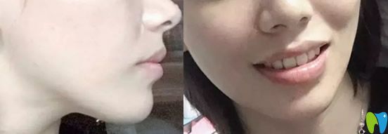 好佰年口腔牙齒矯正完成后圖片