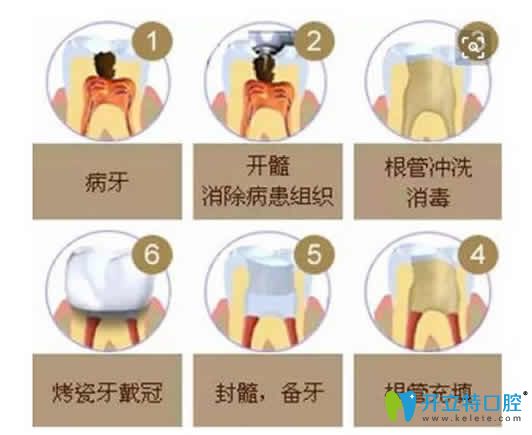 做了根管治療后牙疼怎么辦？根管填充后牙疼正常嗎？