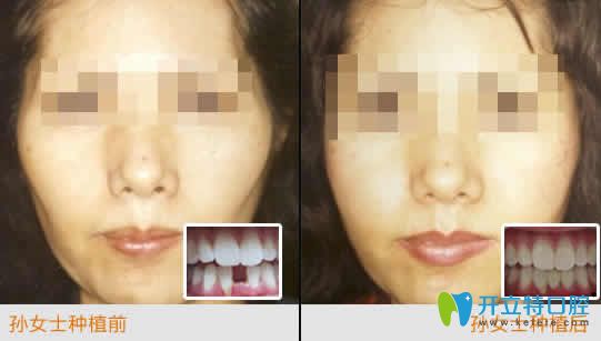 南昌安植雅口腔張明智種植牙案例效果圖 南昌安植雅口腔張明智種植牙案例效果圖