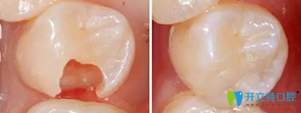 嵌體修復(fù)效果對比圖