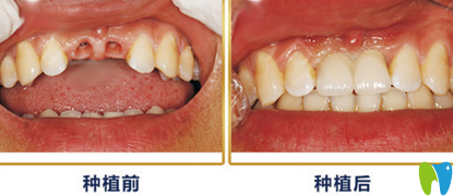 重慶種植牙哪家好？來看牙衛(wèi)士口腔種植牙案例效果