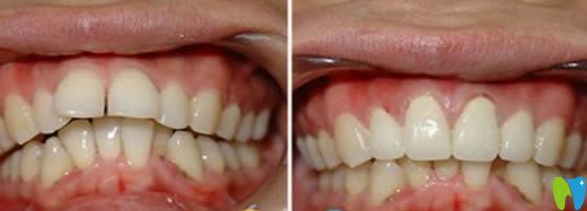 寧波壹加壹口腔茅來發(fā)主任牙齒正畸效果圖