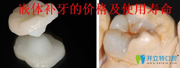 嵌體補牙的價格及使用壽命