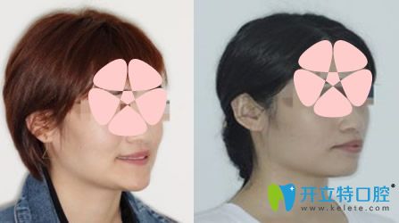 天津英瑞齒科怎么樣，地包天矯正案例來(lái)驗(yàn)證