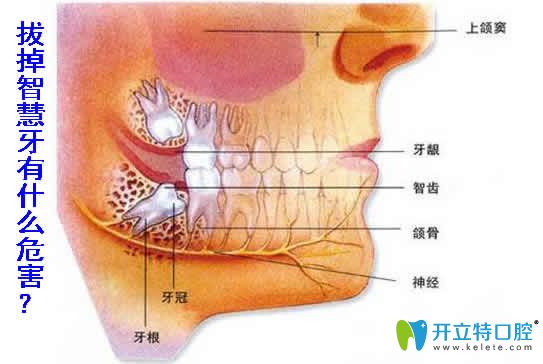 拔掉智慧牙有什么危害