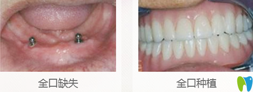 曾凡軍全口牙缺失種植案例前后效果對(duì)比圖