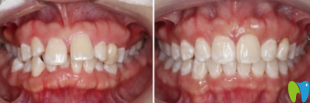 肖丹娜正牙怎么樣？來看顧客正畸后反饋