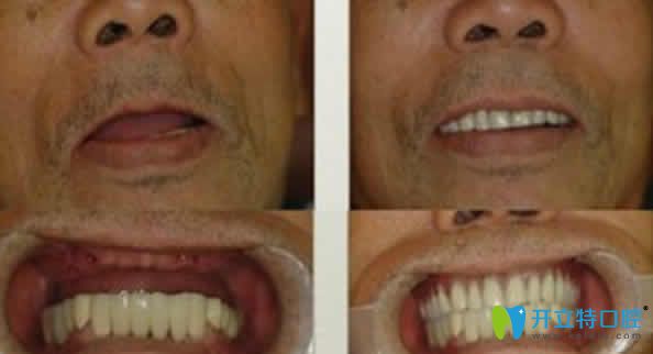 海口國雅口腔種植牙案例效果圖