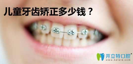兒童牙齒矯正的費用需要多少錢?公布6-15歲兒童箍牙價格表