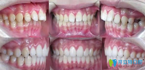 海南國雅口腔牙齒矯正前后對比圖