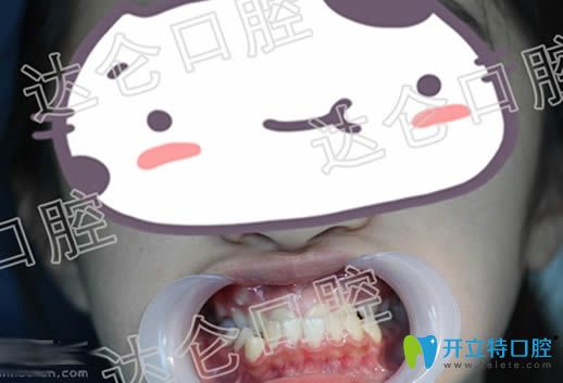 杭州達(dá)侖口腔地包天矯正案例 看9歲孩子反頜矯正效果怎么樣