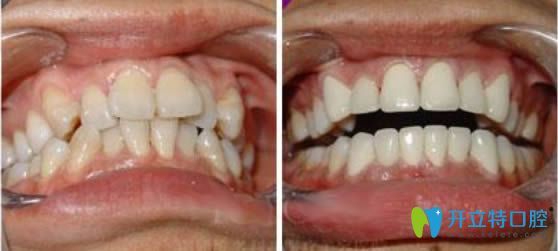 成人牙齒擁擠矯正前后對比照
