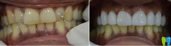 武漢壹加壹口腔牙齒冷光美白對比效果