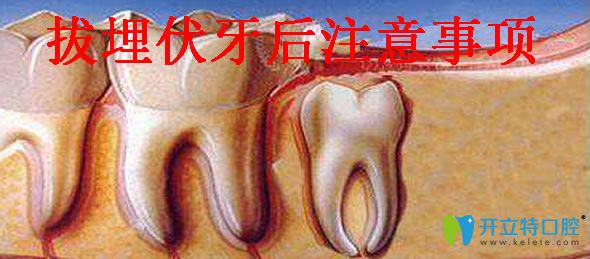 拔埋伏牙的注意事項(xiàng)