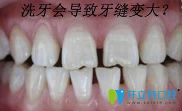 為什么醫(yī)生不推薦洗牙呢,是因為洗牙會導(dǎo)致牙縫變大嗎?
