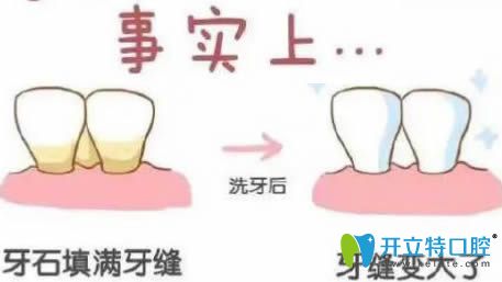 開立特口腔網(wǎng)：洗牙會導(dǎo)致牙縫變大嗎？