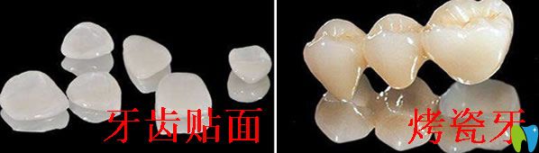 烤瓷牙好還是牙齒貼面好，區(qū)別是什么？具體答案都在這里