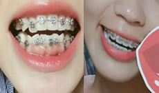 記錄我5個月來在武漢第一口腔醫(yī)院做牙齒正畸的體驗，附圖