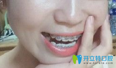 戴鋼絲牙套第109天牙齒變化圖