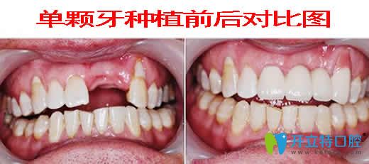 天津德倍爾口腔單顆牙種植效果圖
