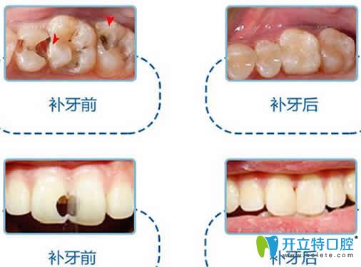 補(bǔ)牙前后對(duì)比圖