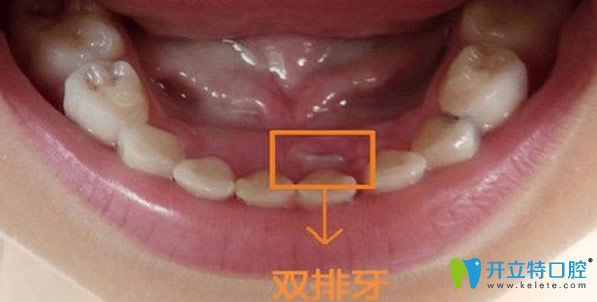 兒童雙排牙會自動歸位嗎?雙排牙要不要拔?真相到底如何