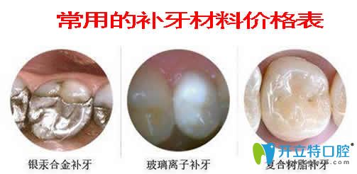 常用的補(bǔ)牙材料價(jià)格表