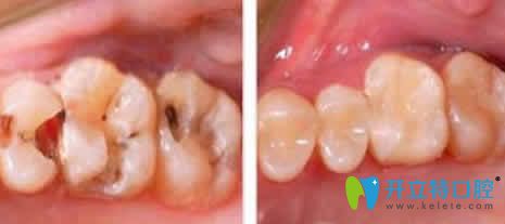 天津愛(ài)齒口腔呂春陽(yáng)根管治療案例效果圖