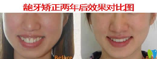 天津德倍爾口腔齙牙矯正兩年效果圖