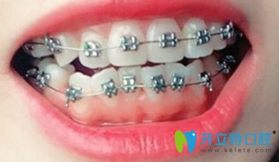 去武漢第 一口腔醫(yī)院做牙齒交矯正30天