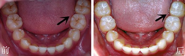 兒童做窩溝封閉到底好不好 分享窩溝封閉后更容易爛牙原因