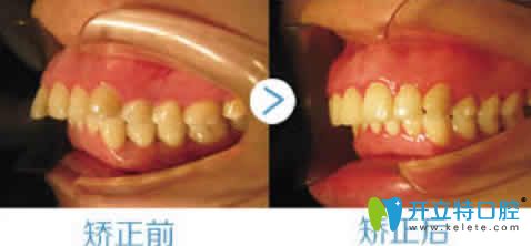 寧波協(xié)禾口腔呂棟主任齙牙矯正真人案例效果 寧波協(xié)禾口腔呂棟主任齙牙矯正真人案例效果