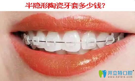 半隱形陶瓷牙套多少錢(qián)？本文提供陶瓷托槽牙齒矯正價(jià)格表