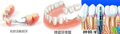 種植牙、活動(dòng)假牙和烤瓷牙哪個(gè)好？看完你就會(huì)明白哦