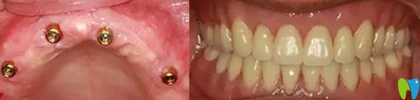 全口牙缺失種植牙前后效果對比圖