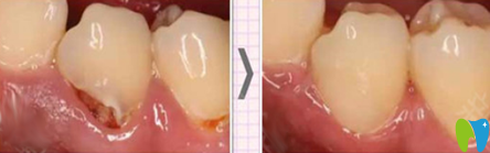泉州補(bǔ)牙哪家好？來看牙博士口腔補(bǔ)牙治療前后對(duì)比案例