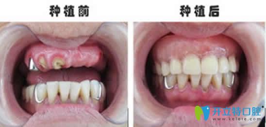 寧波協(xié)禾口腔王昭文院長(zhǎng)種植牙案例效果圖