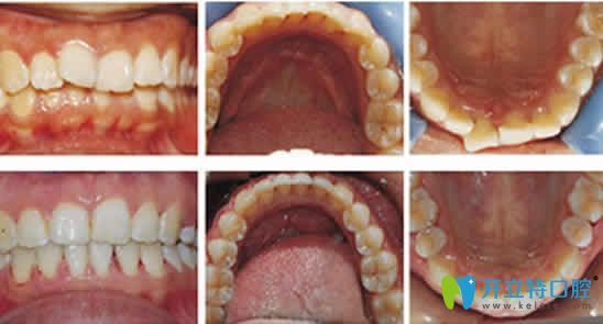 寧波協(xié)禾口腔牙齒矯正前后對(duì)比圖