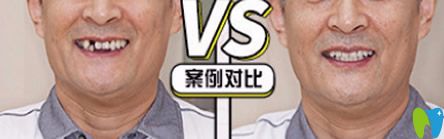 泉州牙博士好不好？牙博士單顆牙缺失即刻種植案例來證明