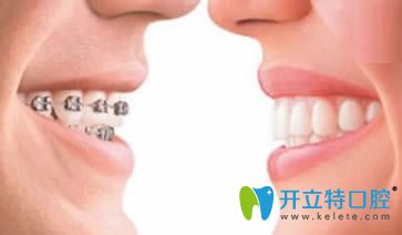 牙齒矯正后會反彈嗎?分享做牙齒矯正反彈的預防及補救方法