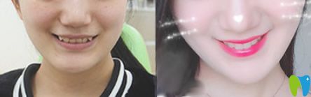 泉州牙博士矯正怎么樣？來看牙博士虎牙和深覆頜隱形矯正前后效果對(duì)比