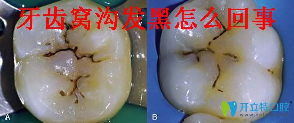 牙齒窩溝黑線怎樣能去除 光固化樹脂補(bǔ)牙縫及補(bǔ)牙價(jià)格分享