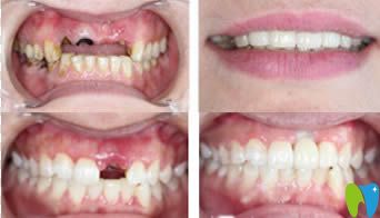 南京江寧藍鱘口腔姚云俊種植牙效果圖