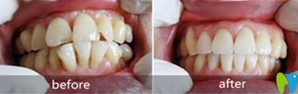 蘇州拜博口腔正畸好嗎？齙牙+牙齒擁擠不齊矯正案例來驗(yàn)證