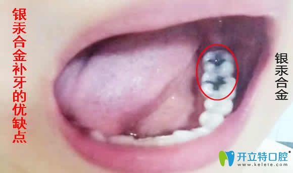 銀汞合金補牙的優(yōu)缺點