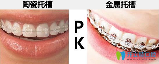 詳解陶瓷托槽矯正和金屬托槽的區(qū)別 想知道牙套價(jià)格看這里