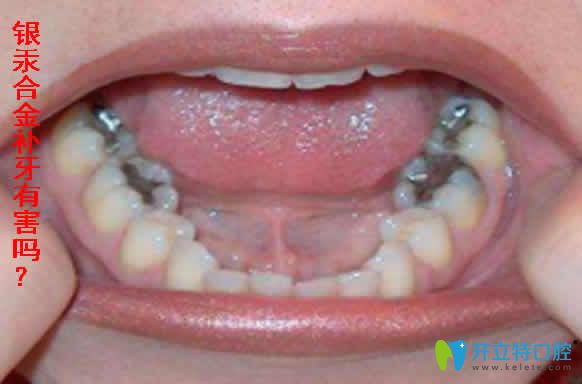 銀汞合金補牙有害嗎
